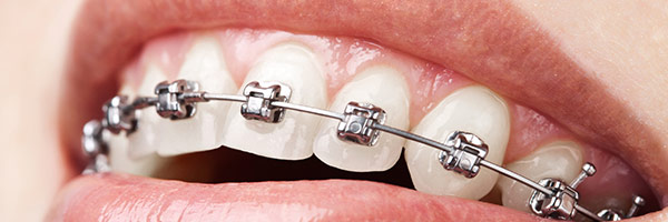 Self-Ligating Braces