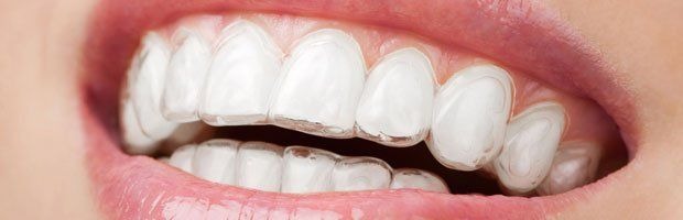 Tallahassee Invisalign